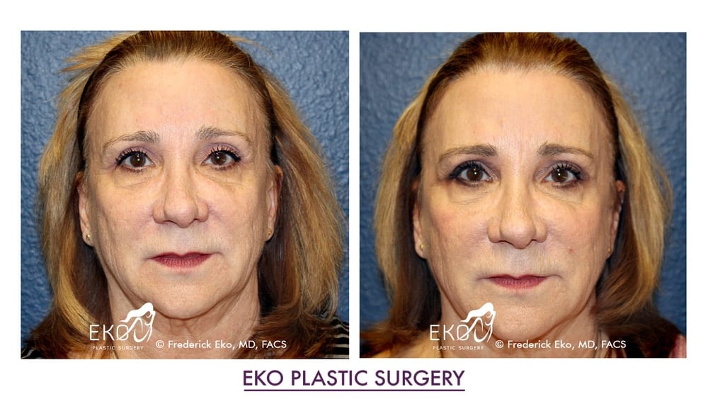 Botox Before and After Photo by Dr. Eko of Eko Plastic Surgery in Palm Desert, CA