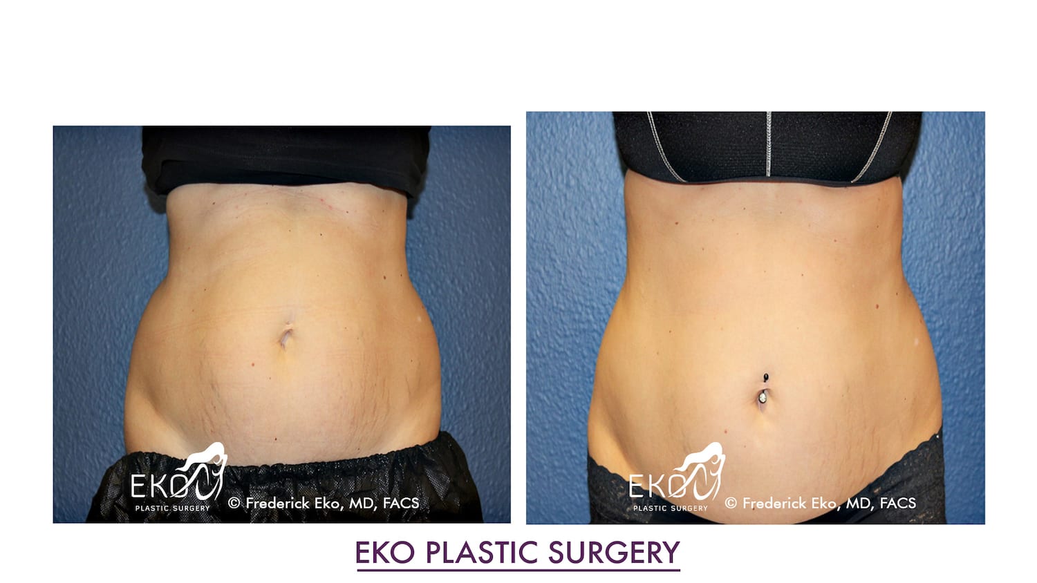 CoolSculpting® Before and After Photo by Dr. Eko of Eko Plastic Surgery in Palm Desert, CA