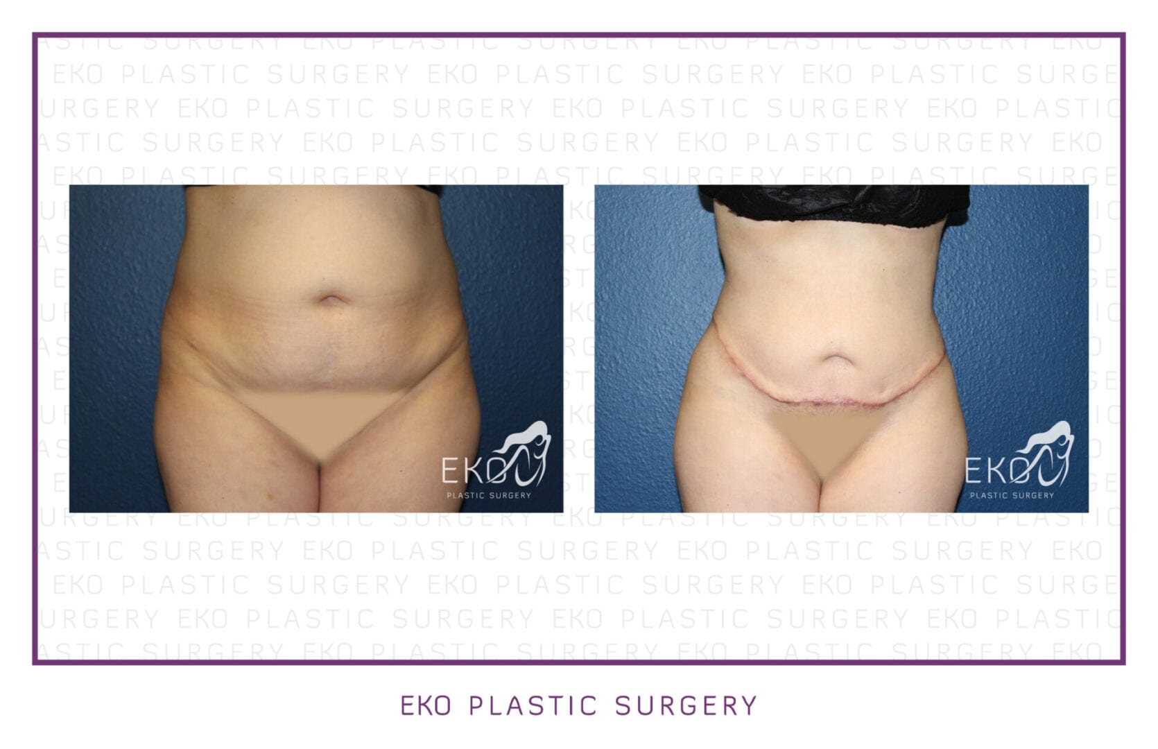 Tummy Tuck (Abdominoplasty) Before and After Photo by Dr. Eko of Eko Plastic Surgery in Palm Desert, CA