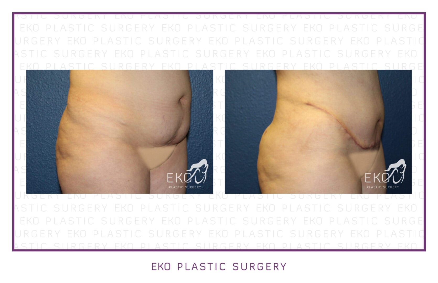 Tummy Tuck (Abdominoplasty) Before and After Photo by Dr. Eko of Eko Plastic Surgery in Palm Desert, CA