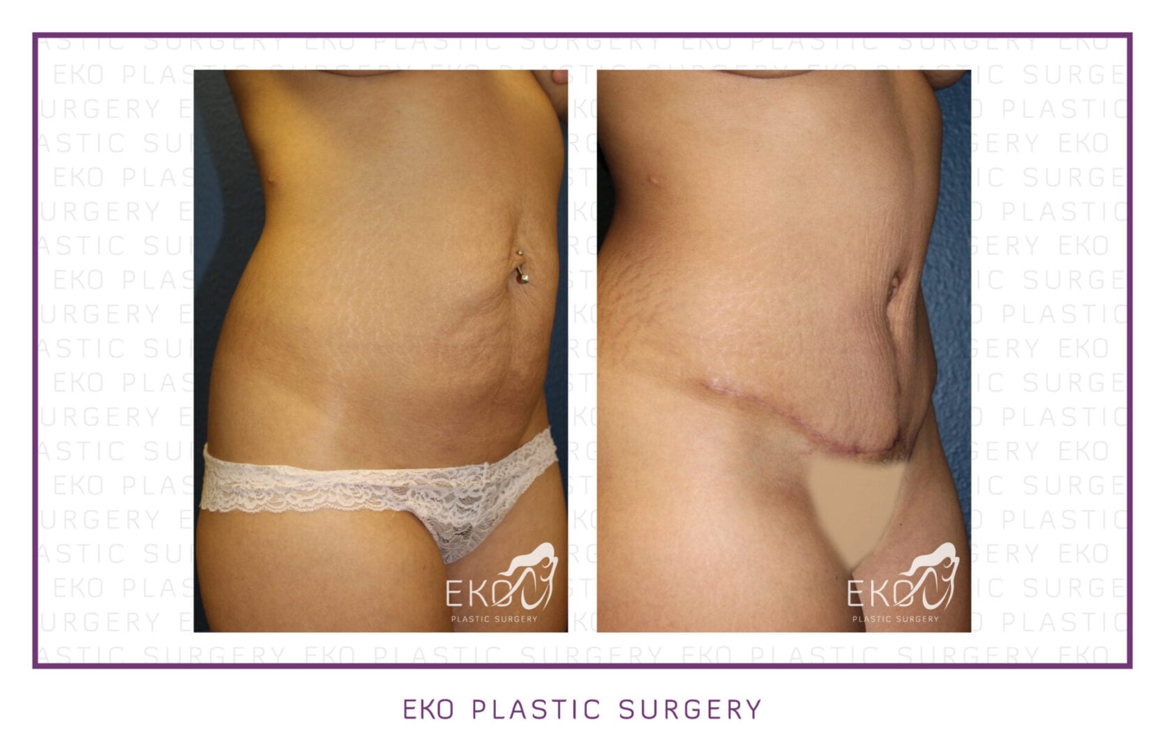 Tummy Tuck (Abdominoplasty) Before and After Photo by Dr. Eko of Eko Plastic Surgery in Palm Desert, CA