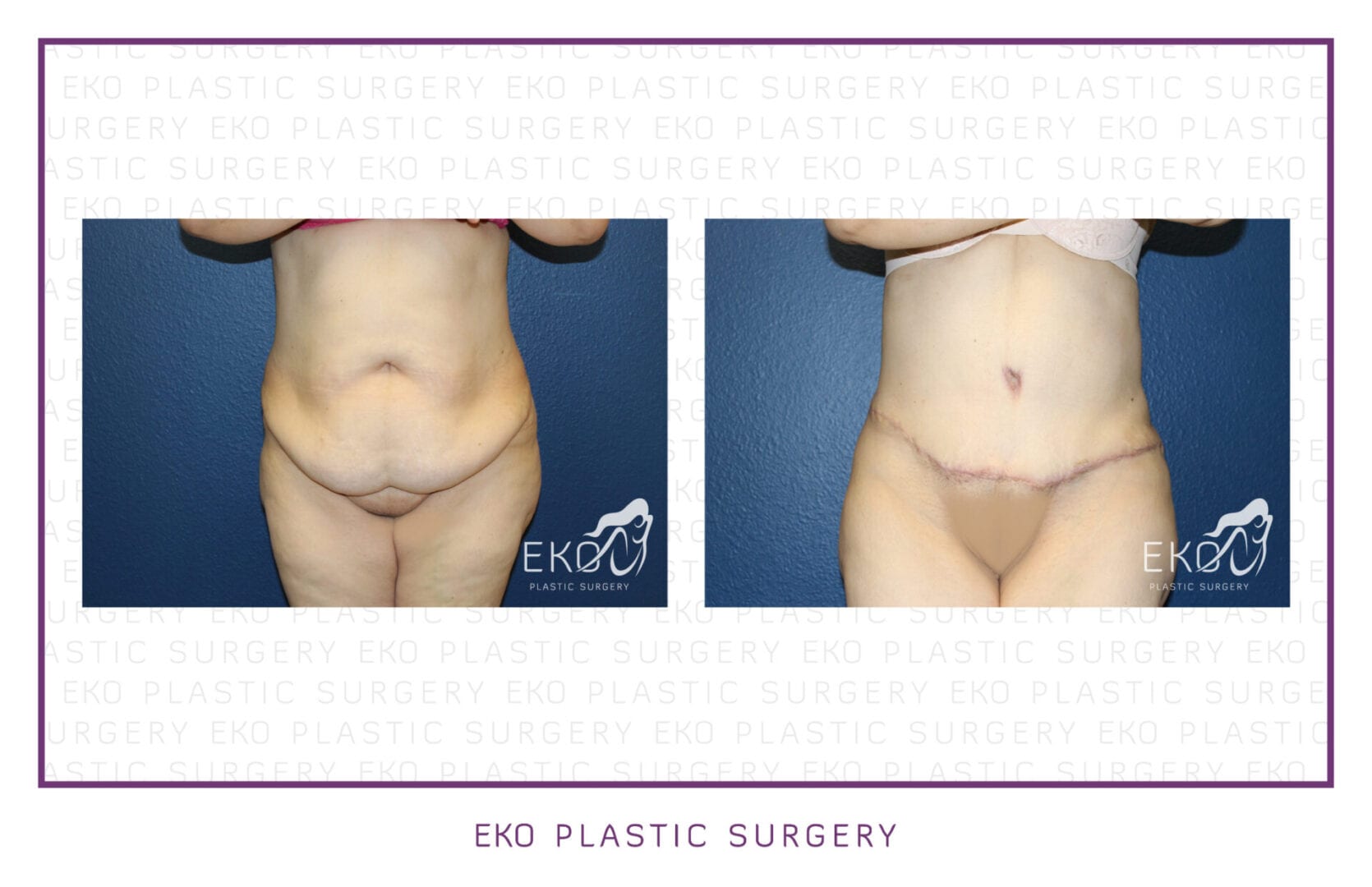 Tummy Tuck (Abdominoplasty) Before and After Photo by Dr. Eko of Eko Plastic Surgery in Palm Desert, CA