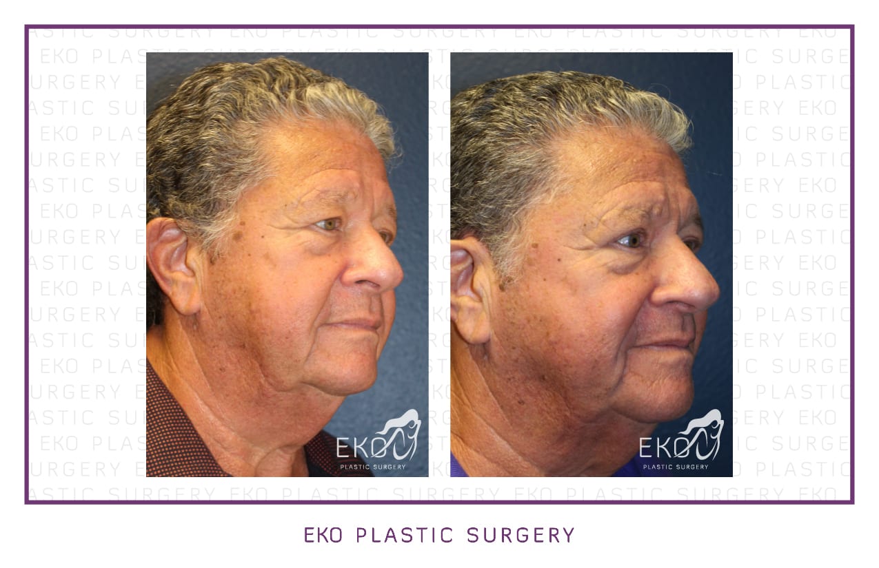 Blepharoplasty Before and After Photo by Dr. Eko of Eko Plastic Surgery in Palm Desert, CA