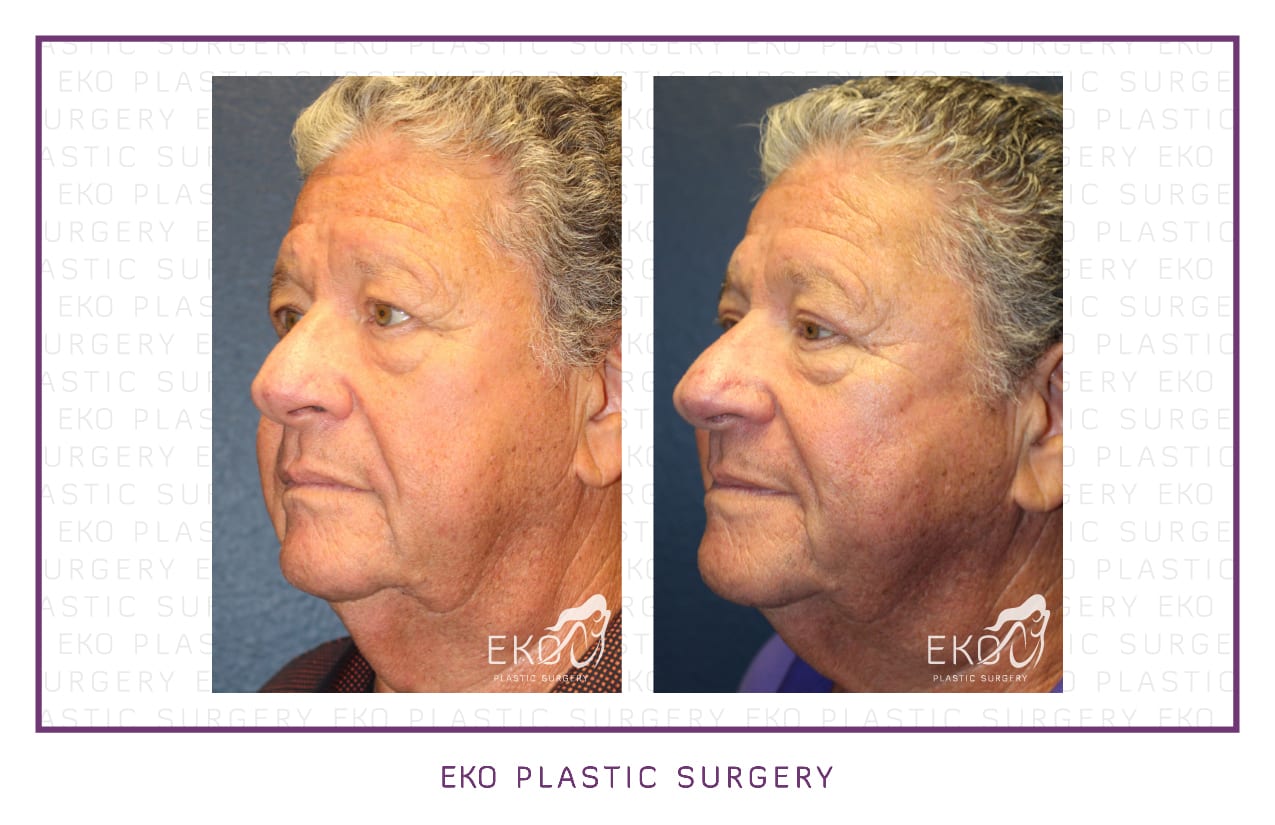 Blepharoplasty Before and After Photo by Dr. Eko of Eko Plastic Surgery in Palm Desert, CA