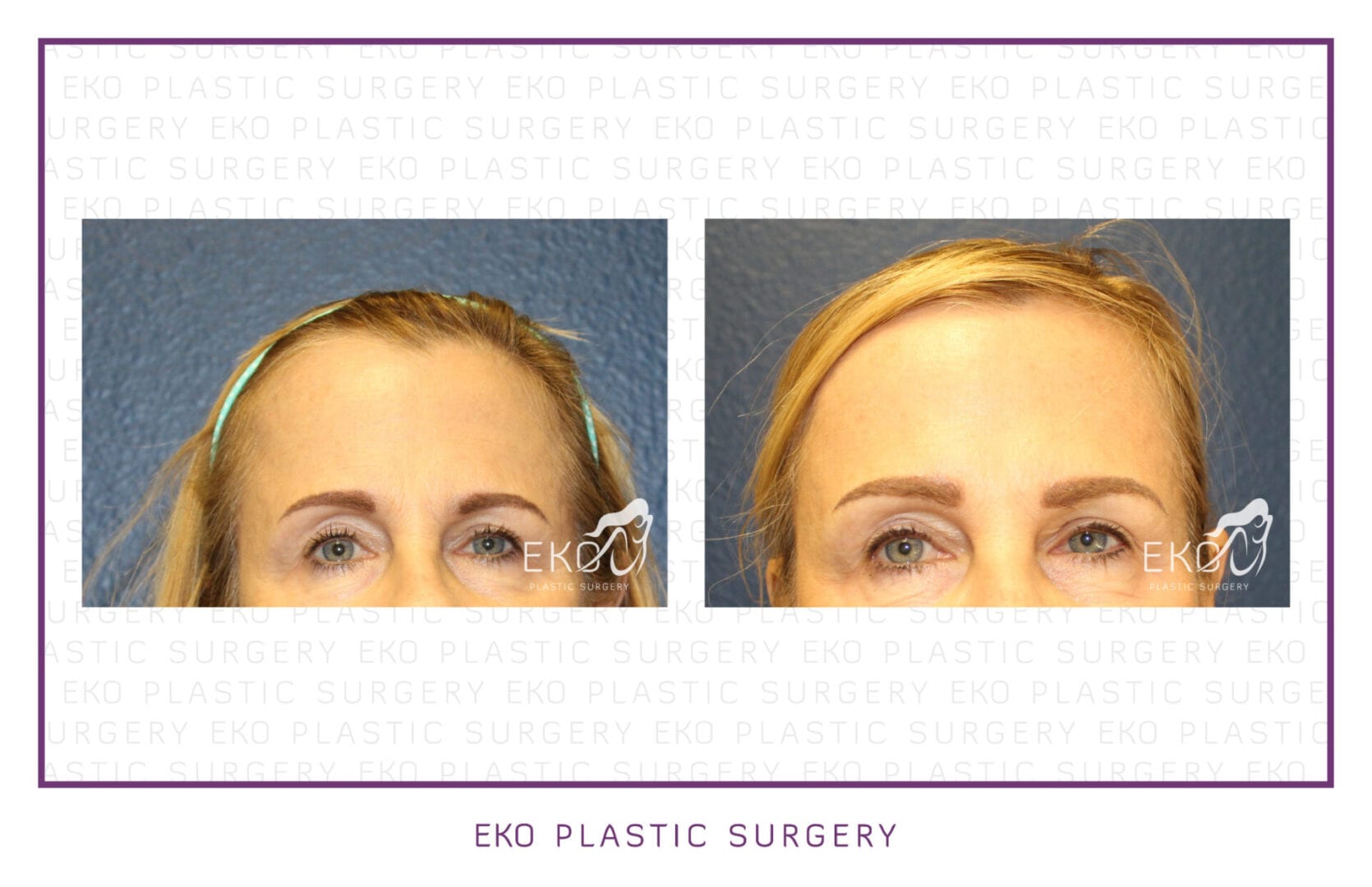 Botox Before and After Photo by Dr. Eko of Eko Plastic Surgery in Palm Desert, CA