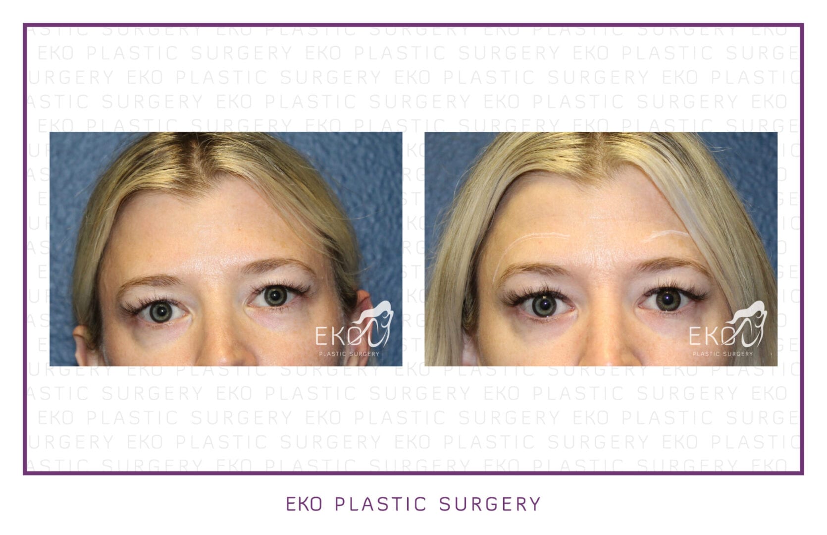 Botox Before and After Photo by Dr. Eko of Eko Plastic Surgery in Palm Desert, CA