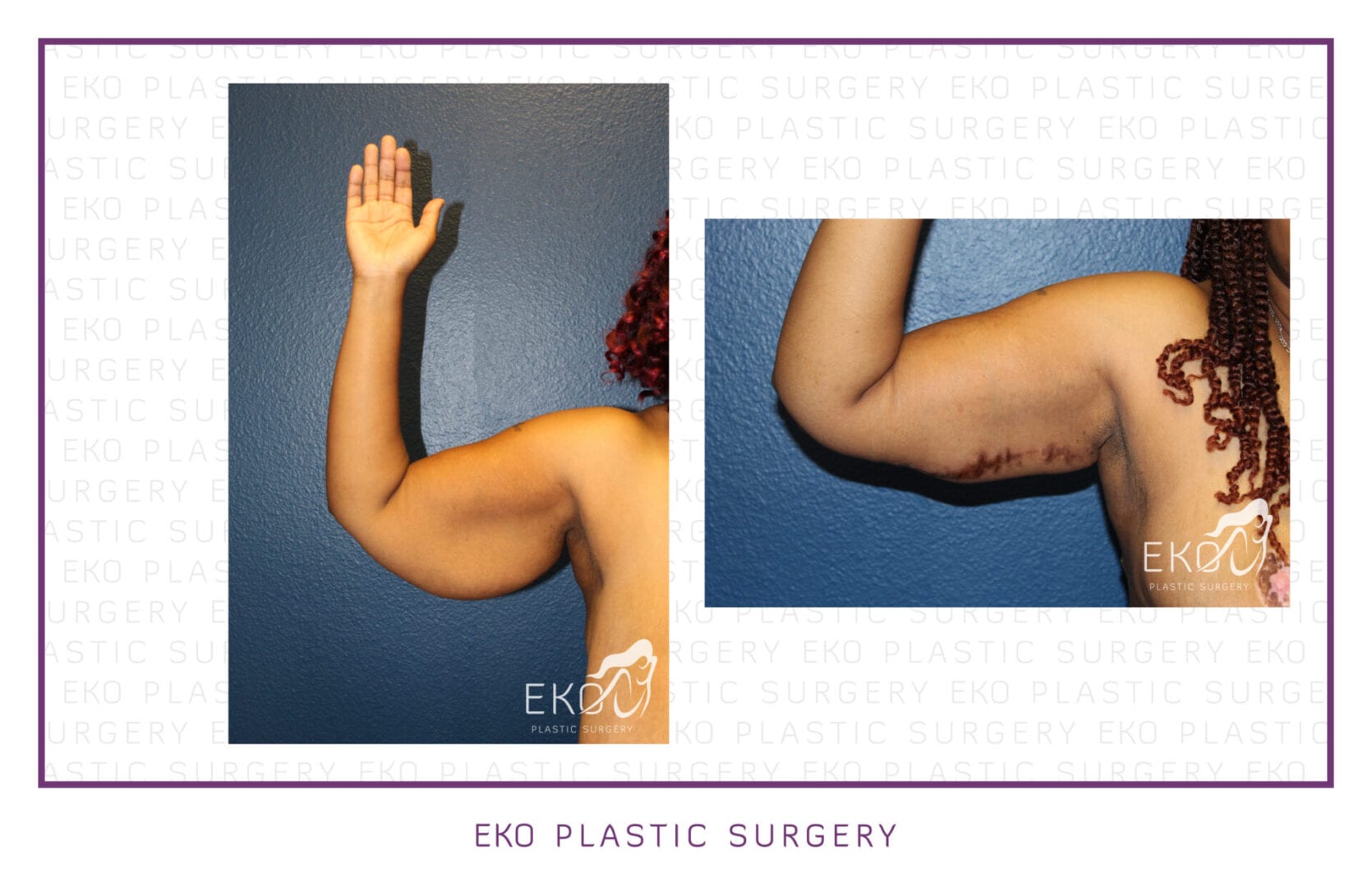 Arm Lift (Brachioplasty) Before and After Photo by Dr. Eko of Eko Plastic Surgery in Palm Desert, CA