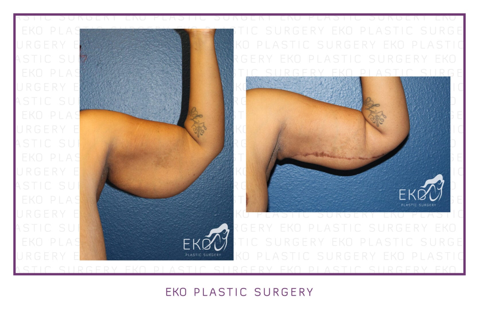 Arm Lift (Brachioplasty) Before and After Photo by Dr. Eko of Eko Plastic Surgery in Palm Desert, CA