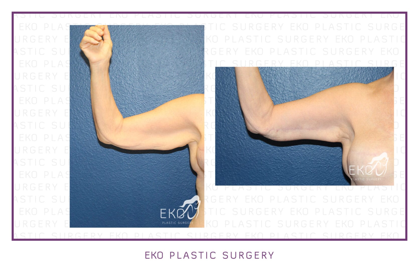 Post-Weight-Loss Procedures Before and After Photo by Dr. Eko of Eko Plastic Surgery in Palm Desert, CA