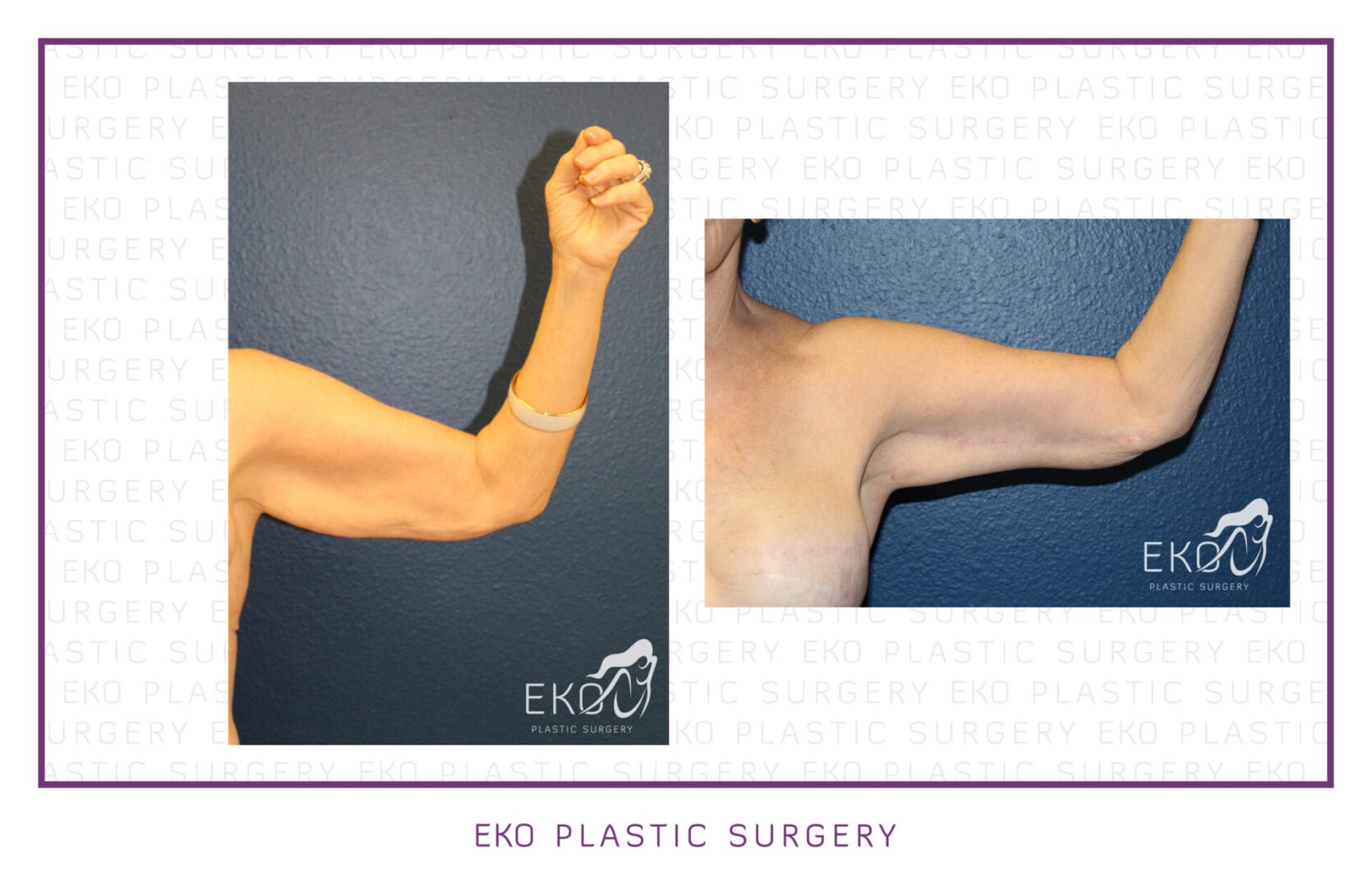 Post-Weight-Loss Procedures Before and After Photo by Dr. Eko of Eko Plastic Surgery in Palm Desert, CA