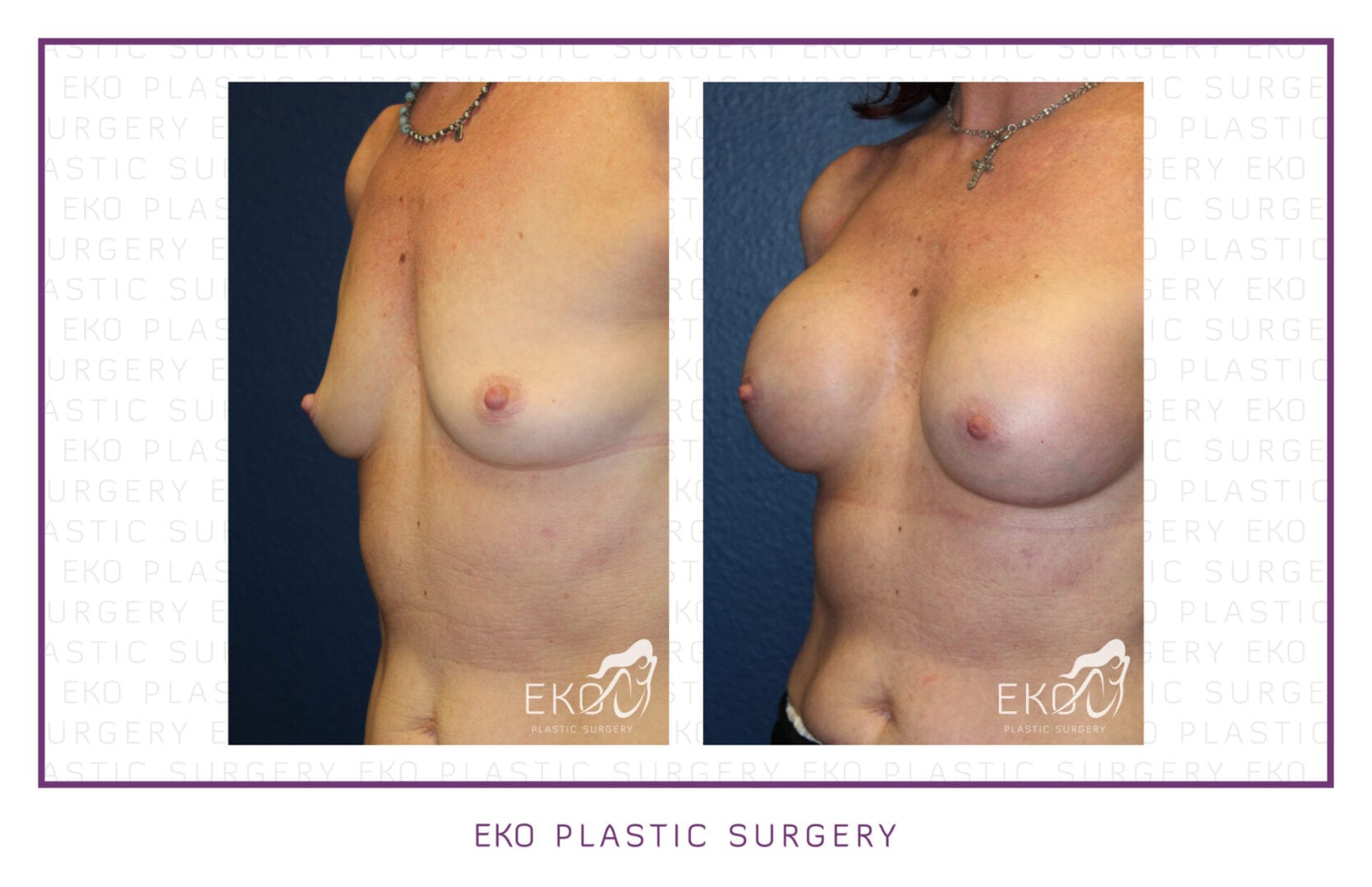 Breast Augmentation Before and After Photo by Dr. Eko of Eko Plastic Surgery in Palm Desert, CA