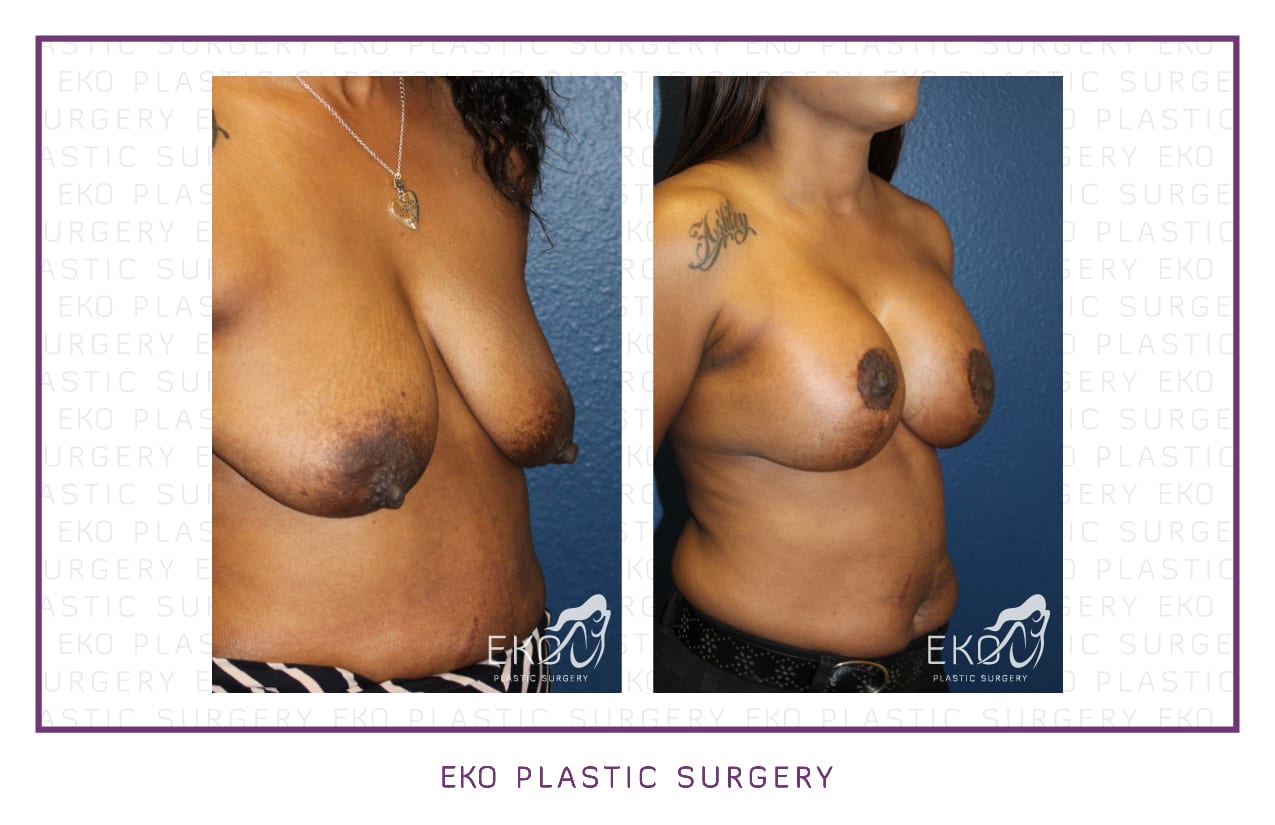 Breast Lift Before and After Photo by Dr. Eko of Eko Plastic Surgery in Palm Desert, CA