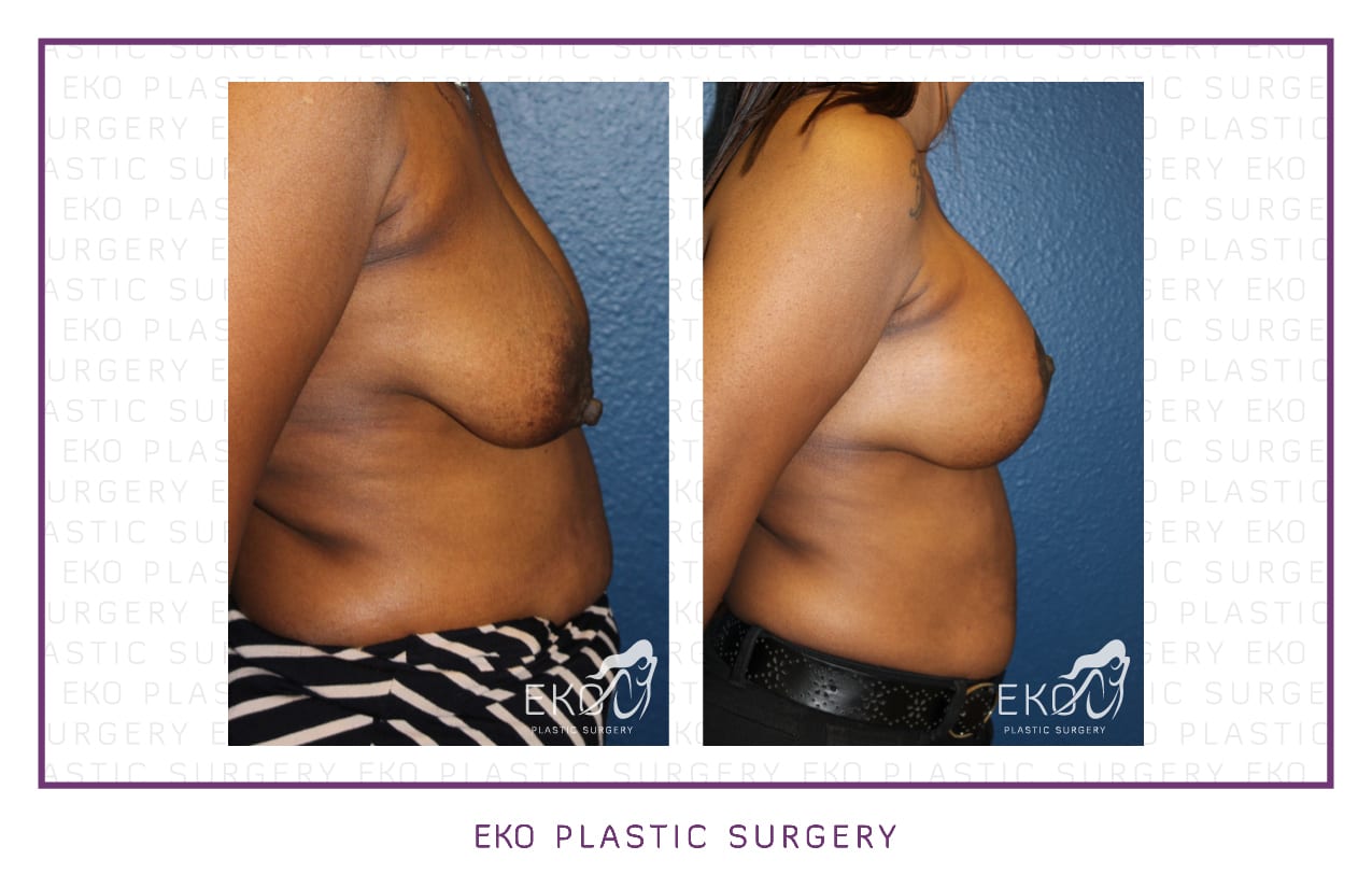 Breast Lift Before and After Photo by Dr. Eko of Eko Plastic Surgery in Palm Desert, CA