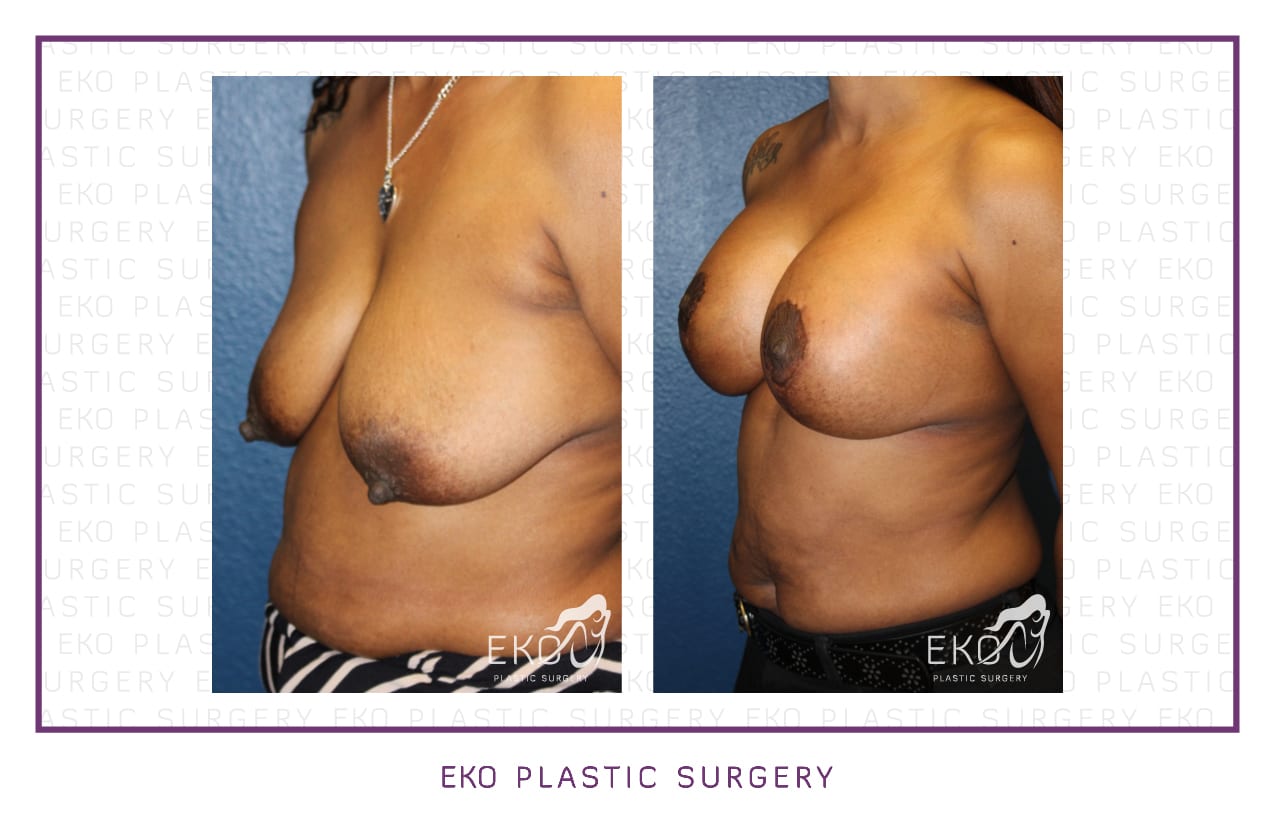 Breast Lift Before and After Photo by Dr. Eko of Eko Plastic Surgery in Palm Desert, CA