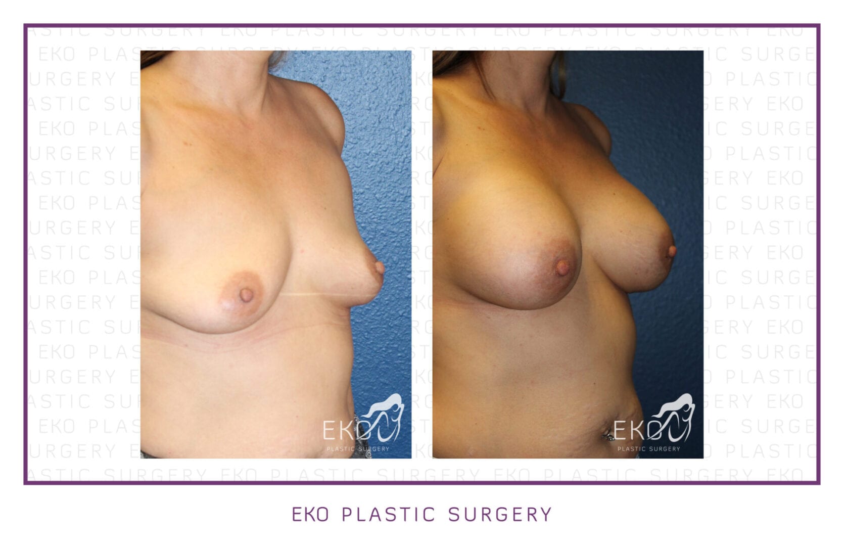 Breast Augmentation Before and After Photo by Dr. Eko of Eko Plastic Surgery in Palm Desert, CA