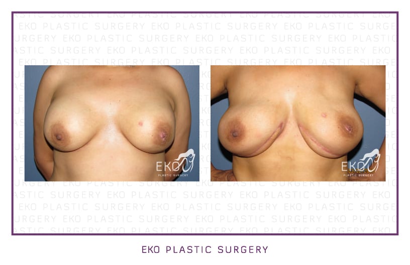 Breast Reconstruction Before and After Photo by Dr. Eko of Eko Plastic Surgery in Palm Desert, CA