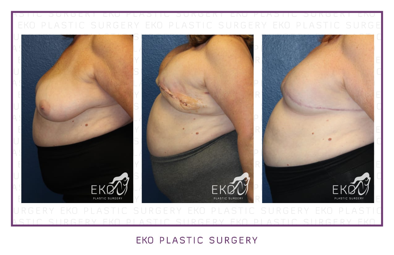 Breast Reconstruction Before and After Photo by Dr. Eko of Eko Plastic Surgery in Palm Desert, CA