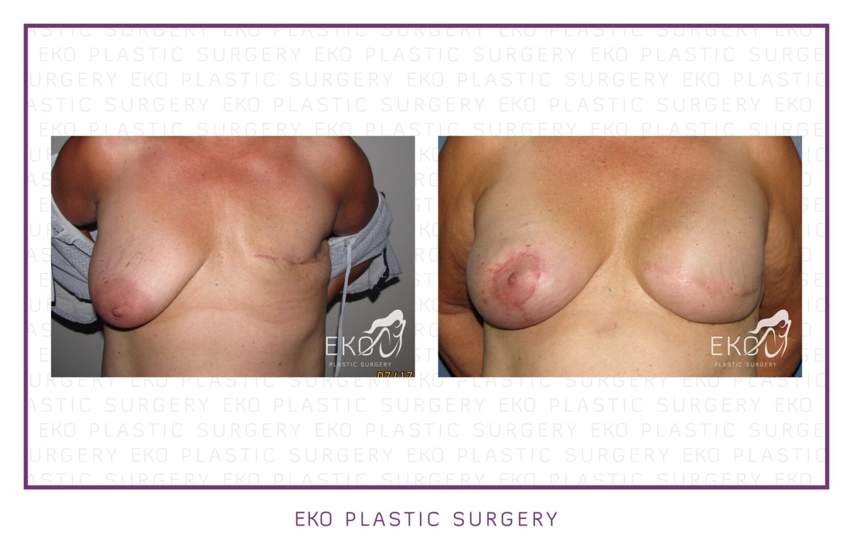 Breast Reconstruction Before and After Photo by Dr. Eko of Eko Plastic Surgery in Palm Desert, CA