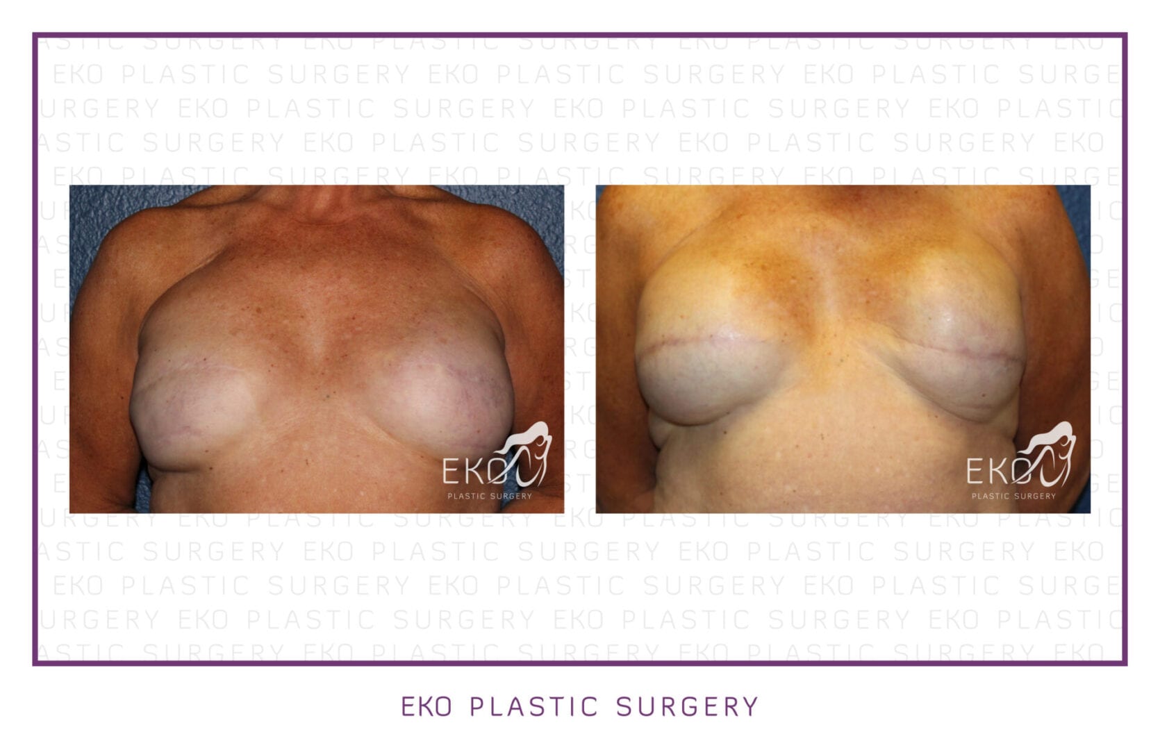 Breast Reconstruction Before and After Photo by Dr. Eko of Eko Plastic Surgery in Palm Desert, CA