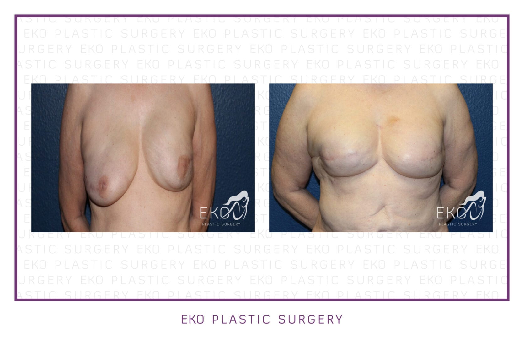 Breast Reconstruction Before and After Photo by Dr. Eko of Eko Plastic Surgery in Palm Desert, CA