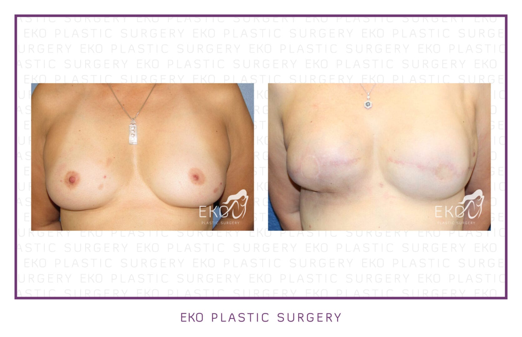 Breast Reconstruction Before and After Photo by Dr. Eko of Eko Plastic Surgery in Palm Desert, CA