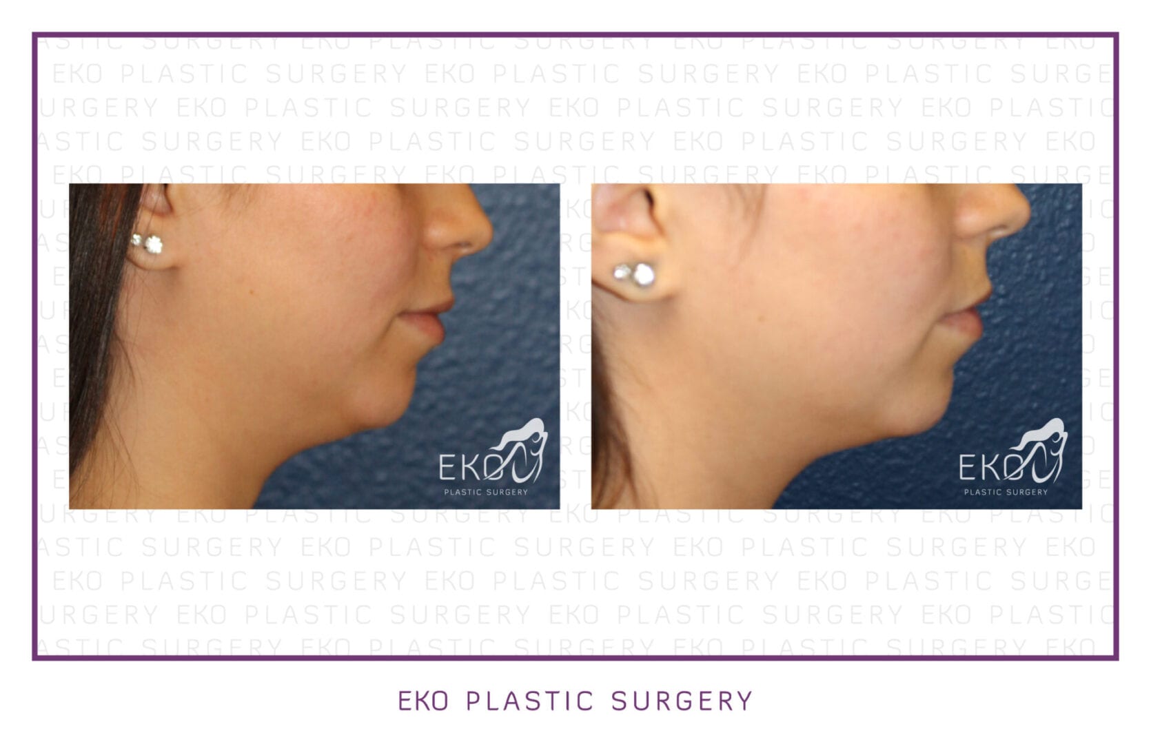 Kybella® Before and After Photo by Dr. Eko of Eko Plastic Surgery in Palm Desert, CA