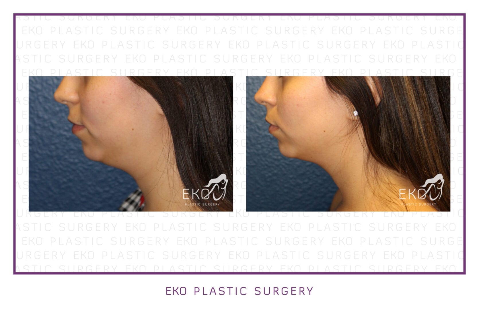Kybella® Before and After Photo by Dr. Eko of Eko Plastic Surgery in Palm Desert, CA