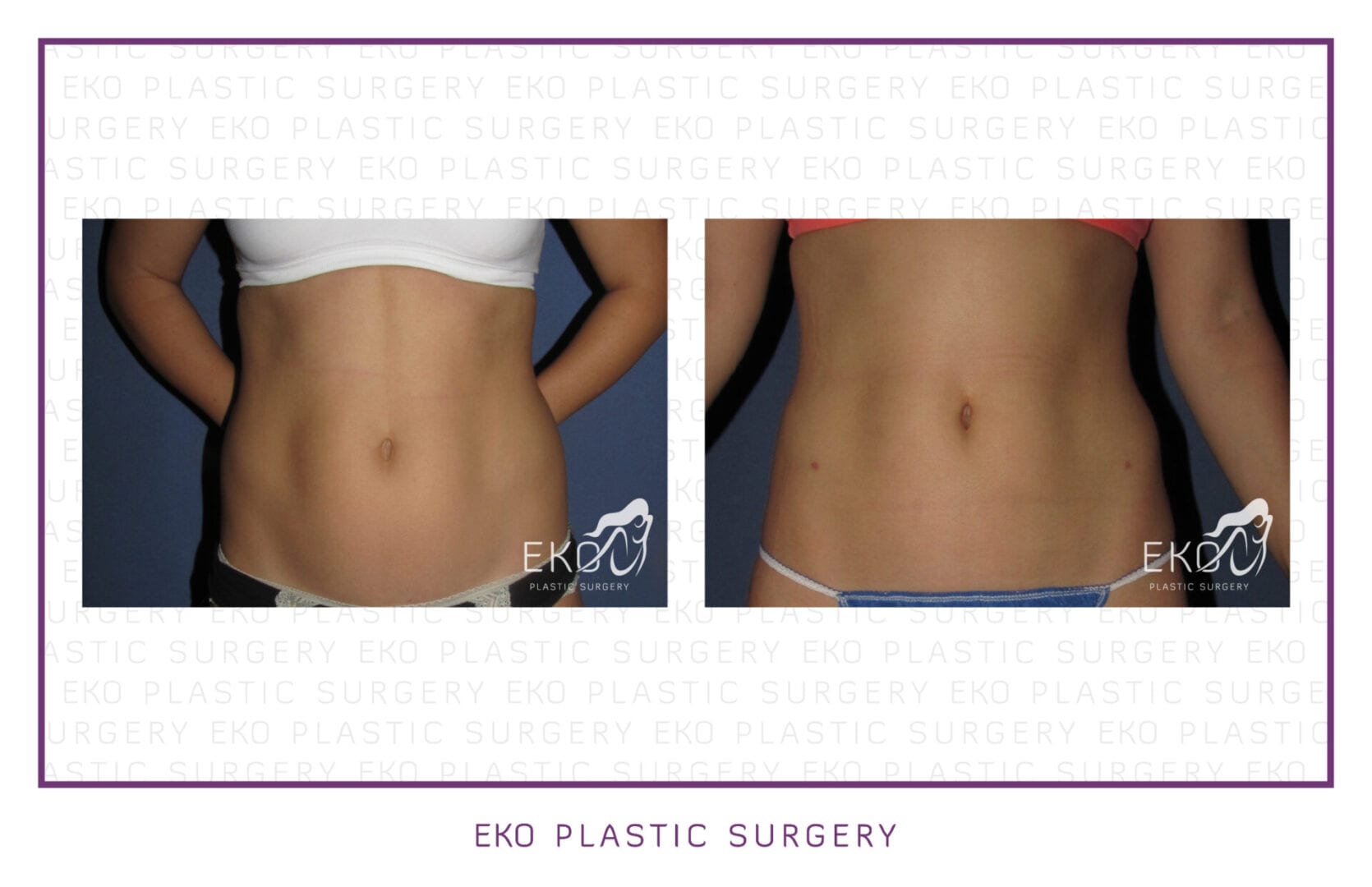 Liposuction Before and After Photo by Dr. Eko of Eko Plastic Surgery in Palm Desert, CA