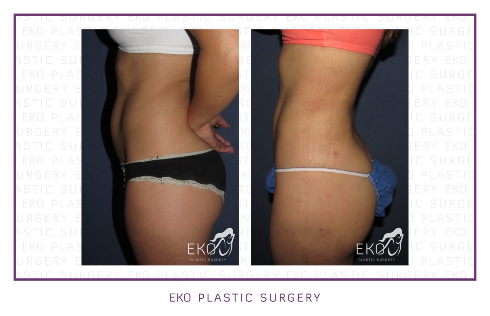 Liposuction Before and After Photo by Dr. Eko of Eko Plastic Surgery in Palm Desert, CA