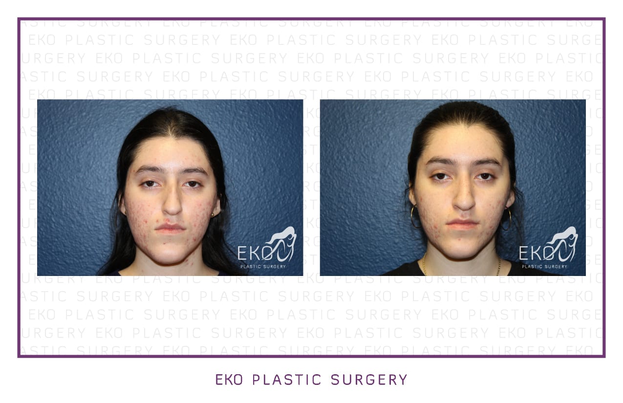 Rhinoplasty Before and After Photo by Dr. Eko of Eko Plastic Surgery in Palm Desert, CA