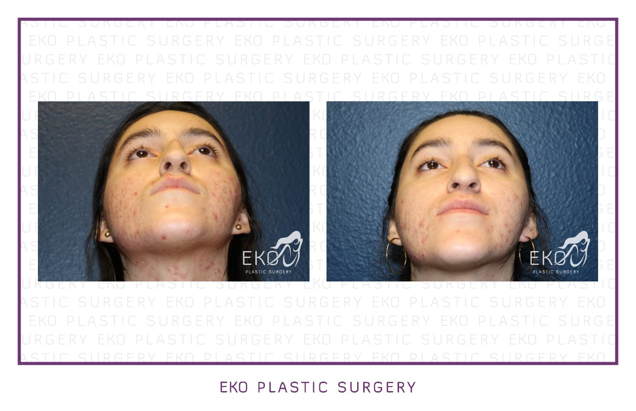 Rhinoplasty Before and After Photo by Dr. Eko of Eko Plastic Surgery in Palm Desert, CA