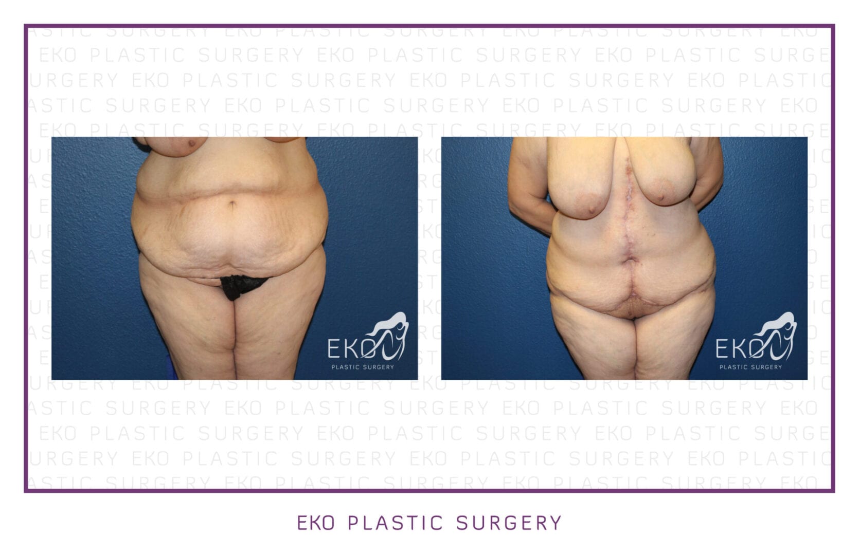 Post-Weight-Loss Procedures Before and After Photo by Dr. Eko of Eko Plastic Surgery in Palm Desert, CA