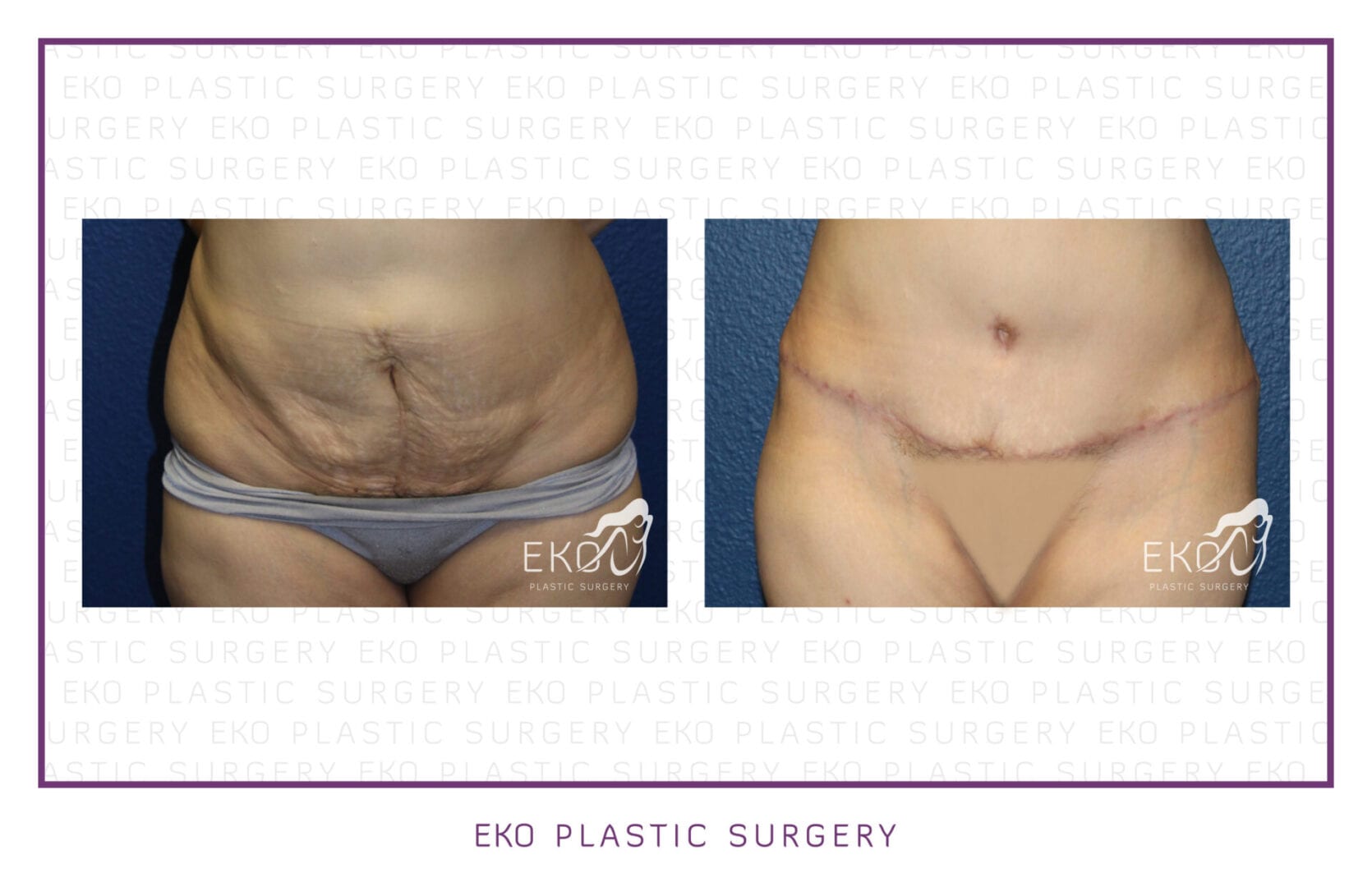 Tummy Tuck (Abdominoplasty) Before and After Photo by Dr. Eko of Eko Plastic Surgery in Palm Desert, CA