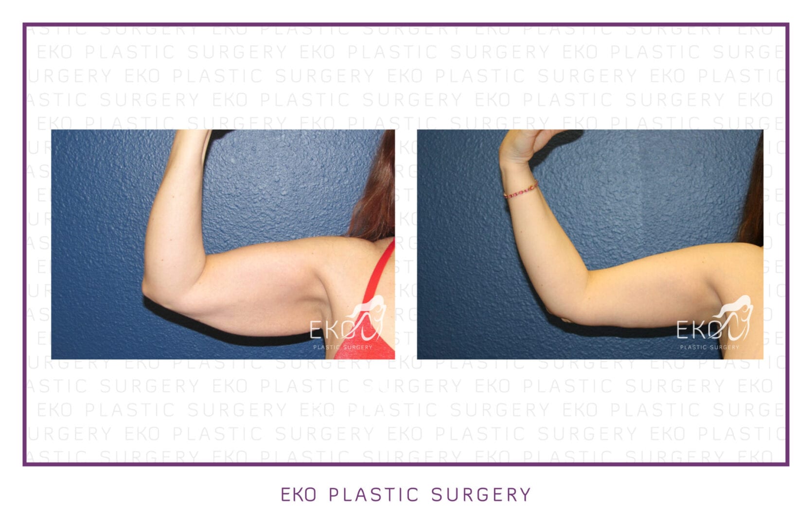 Post-Weight-Loss Procedures Before and After Photo by Dr. Eko of Eko Plastic Surgery in Palm Desert, CA