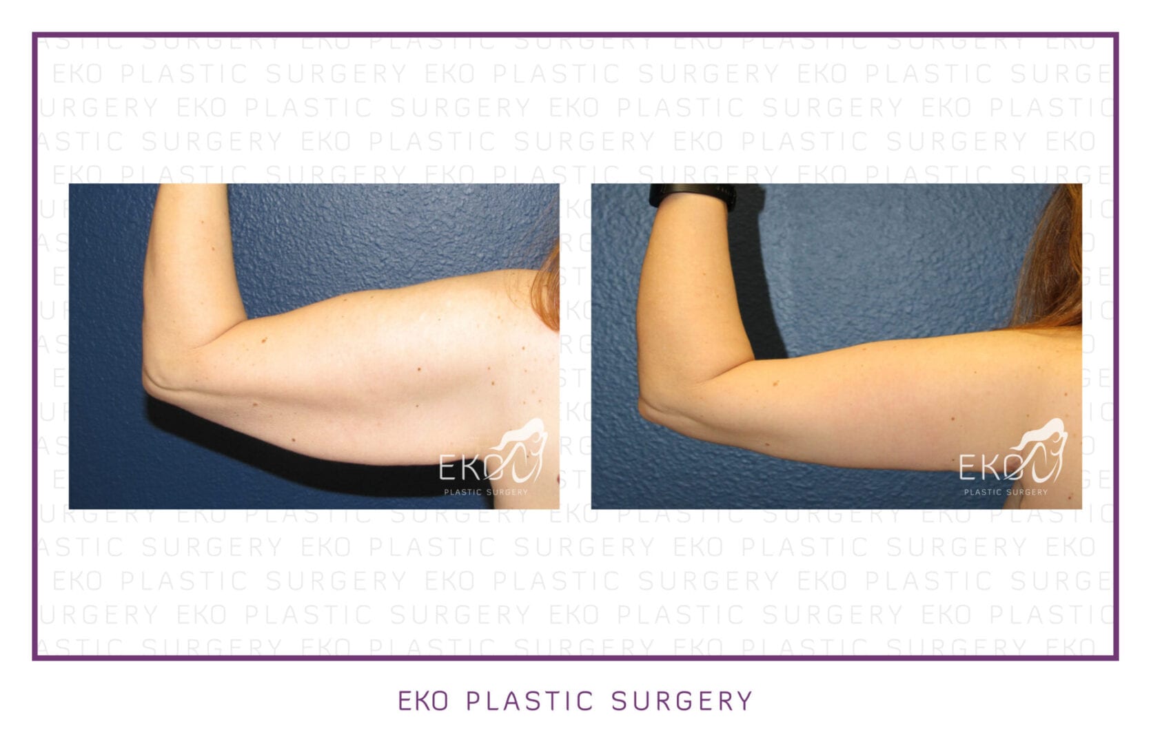 Post-Weight-Loss Procedures Before and After Photo by Dr. Eko of Eko Plastic Surgery in Palm Desert, CA
