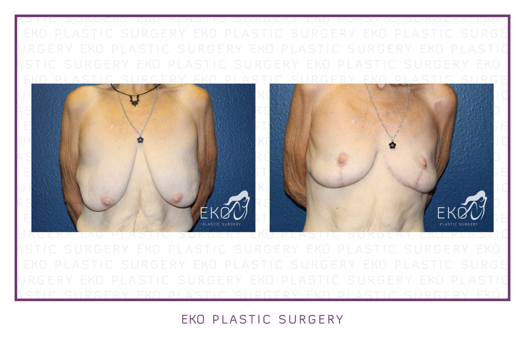 Post-Weight-Loss Procedures Before and After Photo by Dr. Eko of Eko Plastic Surgery in Palm Desert, CA