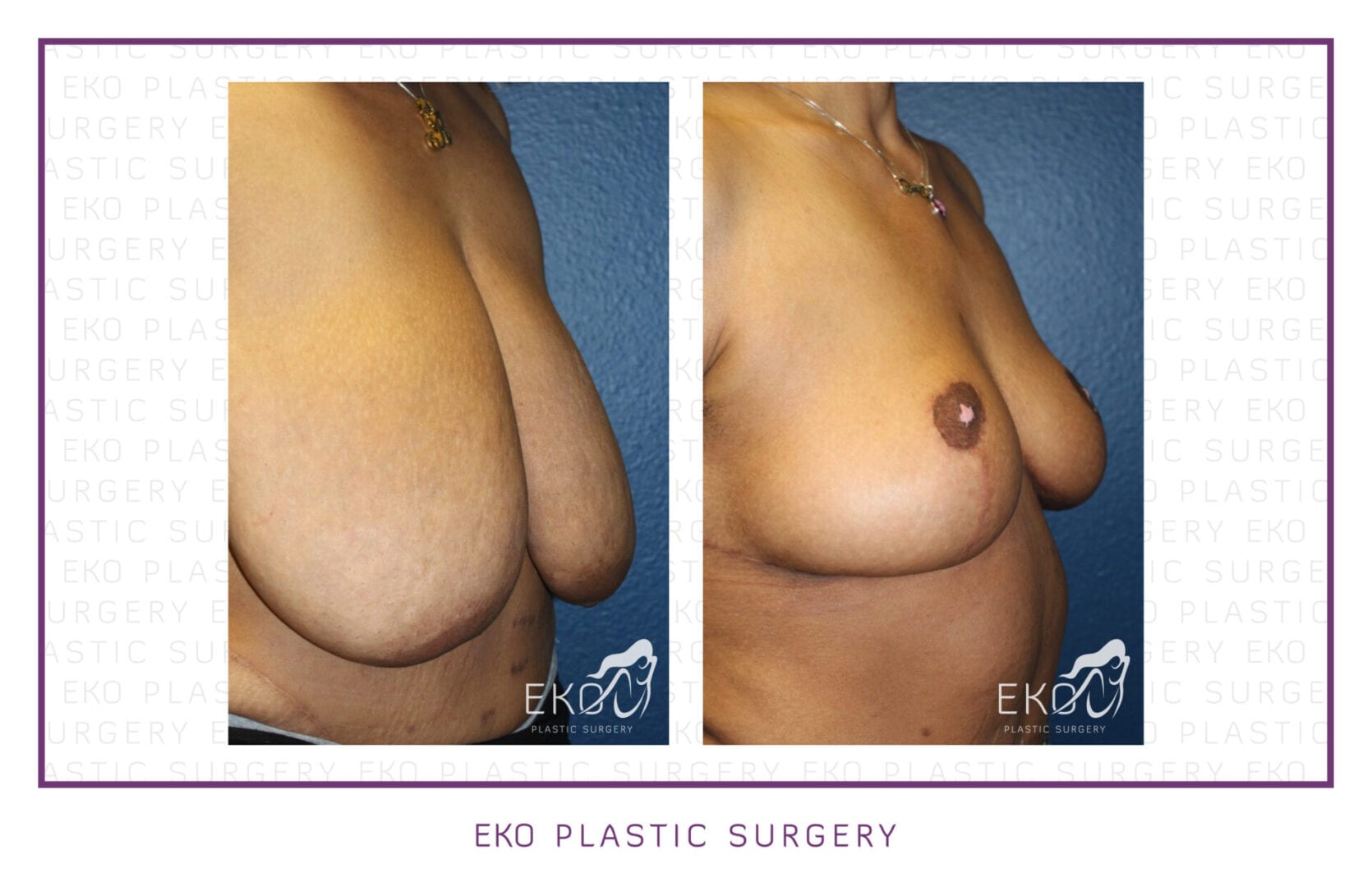 Breast Reduction Before and After Photo by Dr. Eko of Eko Plastic Surgery in Palm Desert, CA
