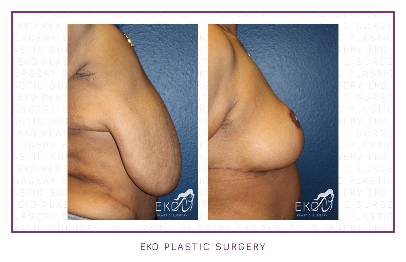 Breast Reduction Before and After Photo by Dr. Eko of Eko Plastic Surgery in Palm Desert, CA