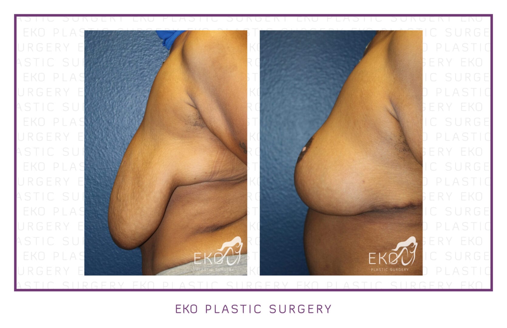 Breast Reduction Before and After Photo by Dr. Eko of Eko Plastic Surgery in Palm Desert, CA