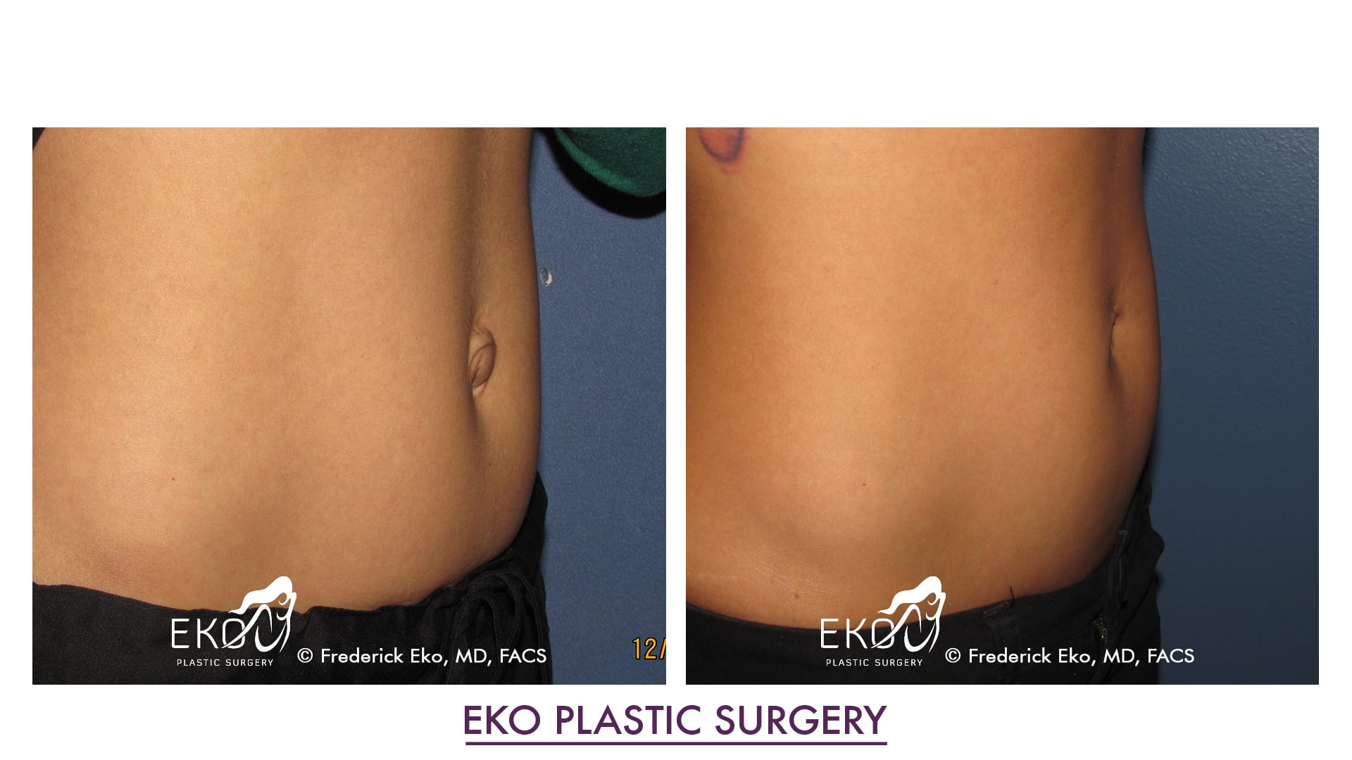 Belly Button surgery (Umbilicoplasty) Before and After Photo by Dr. Eko of Eko Plastic Surgery in Palm Desert, CA