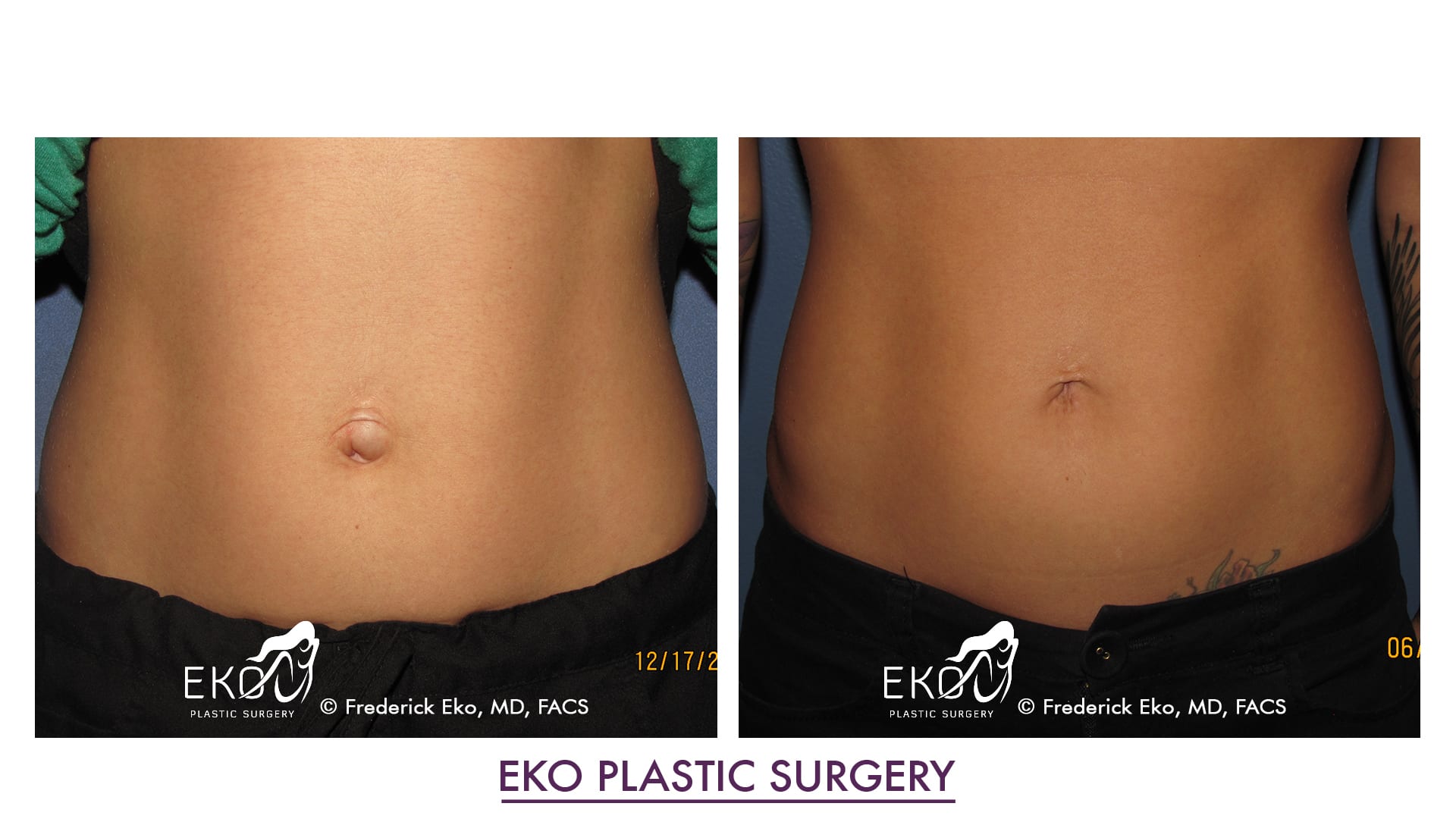 Belly Button surgery (Umbilicoplasty) Before and After Photo by Dr. Eko of Eko Plastic Surgery in Palm Desert, CA