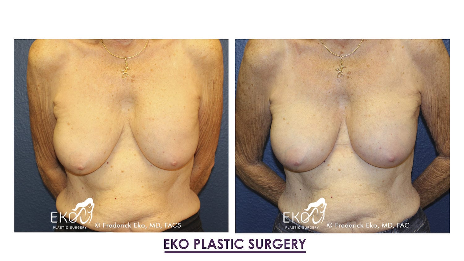 Breast Augmentation Revision Before and After Photo by Dr. Eko of Eko Plastic Surgery in Palm Desert, CA