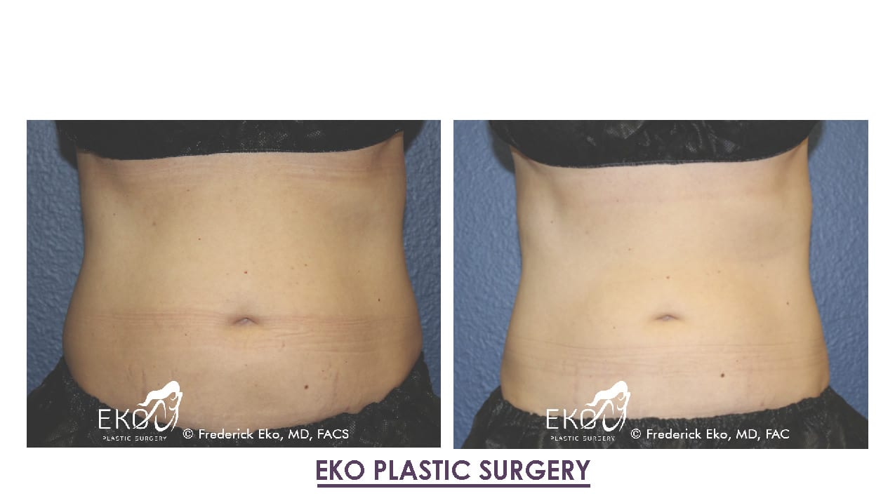 CoolSculpting® Before and After Photo by Dr. Eko of Eko Plastic Surgery in Palm Desert, CA