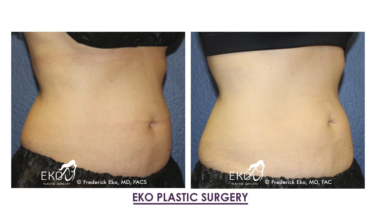 CoolSculpting® Before and After Photo by Dr. Eko of Eko Plastic Surgery in Palm Desert, CA
