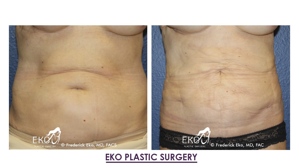 Liposuction Before and After Photo by Dr. Eko of Eko Plastic Surgery in Palm Desert, CA