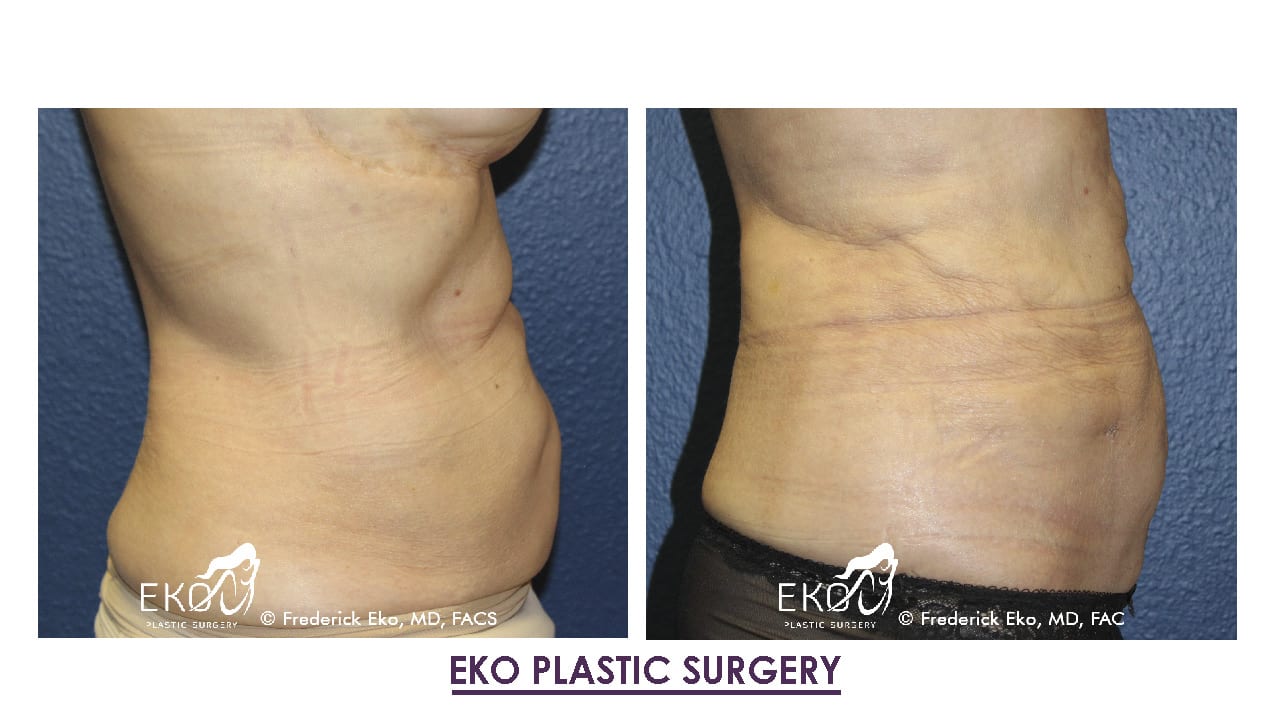Liposuction Before and After Photo by Dr. Eko of Eko Plastic Surgery in Palm Desert, CA