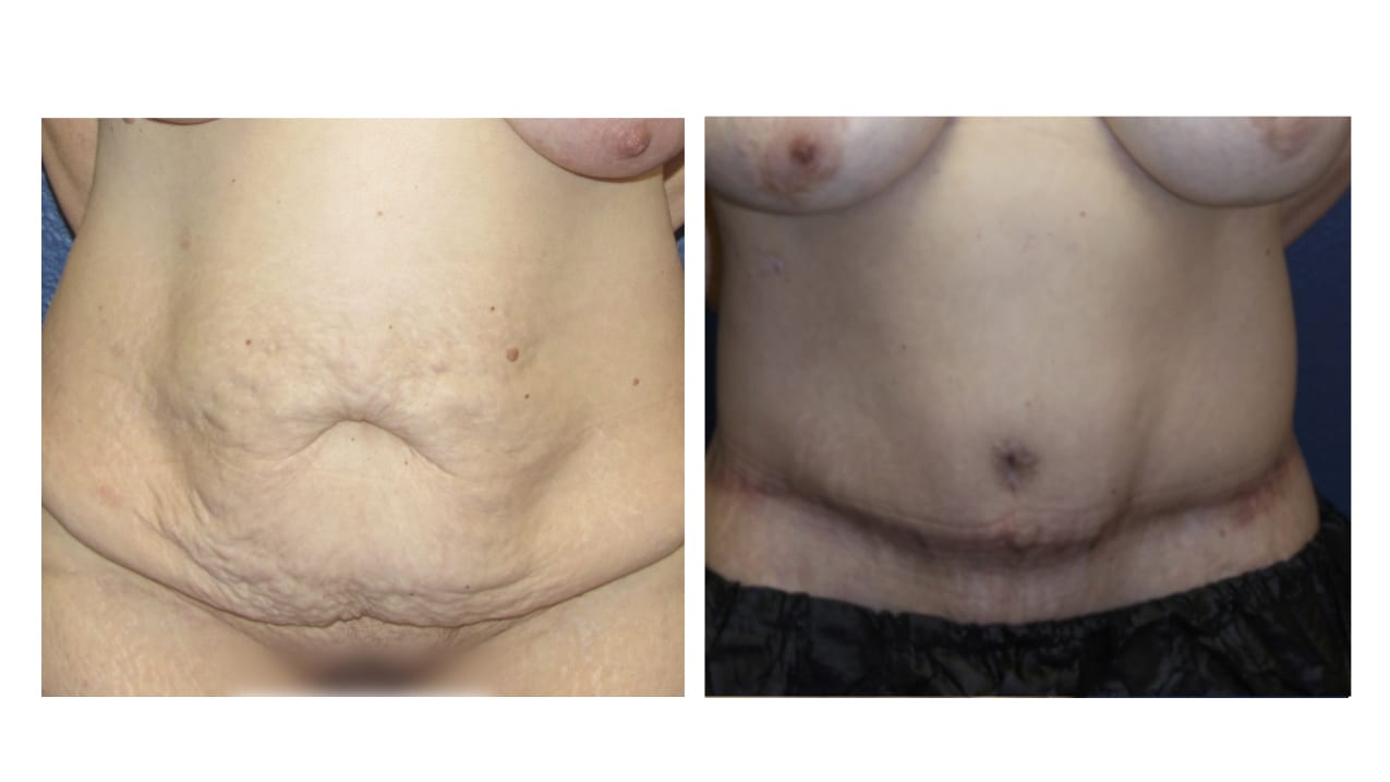 Post-Weight-Loss Procedures Before and After Photo by Dr. Eko of Eko Plastic Surgery in Palm Desert, CA