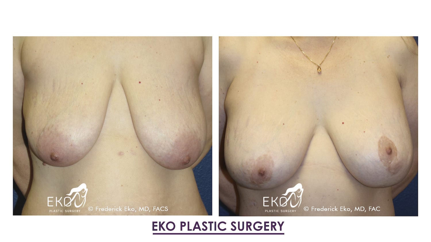 Post-Weight-Loss Procedures Before and After Photo by Dr. Eko of Eko Plastic Surgery in Palm Desert, CA