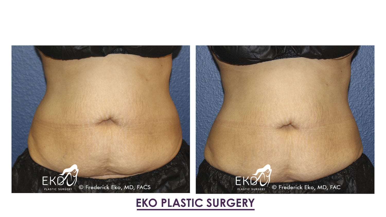 CoolSculpting® Before and After Photo by Dr. Eko of Eko Plastic Surgery in Palm Desert, CA