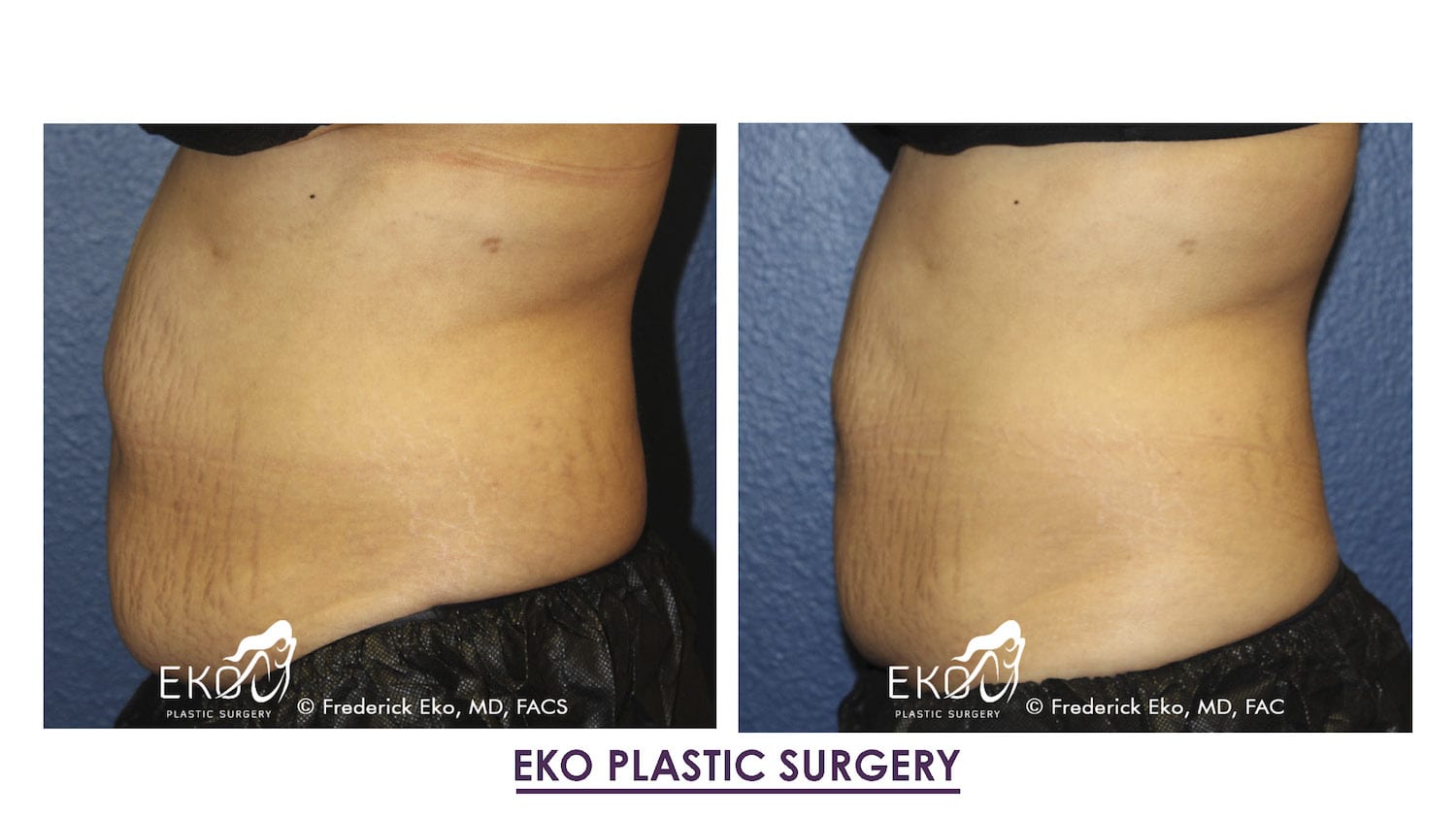 CoolSculpting® Before and After Photo by Dr. Eko of Eko Plastic Surgery in Palm Desert, CA